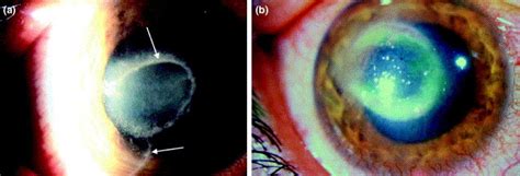 Acanthamoeba Keratitis Parasite