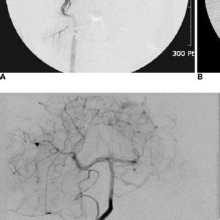 Case A Anteroposterior View Of Left Vertebral Artery Angiogram Shows