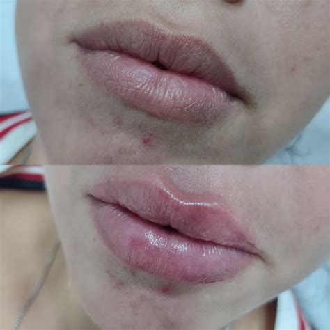 Preenchimento Labial DR Igor Ramos