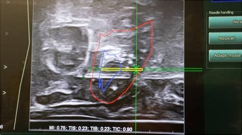 Rezonans Magnetyczny Prostaty I Biopsja Fuzyjna Urologia Da Vinci