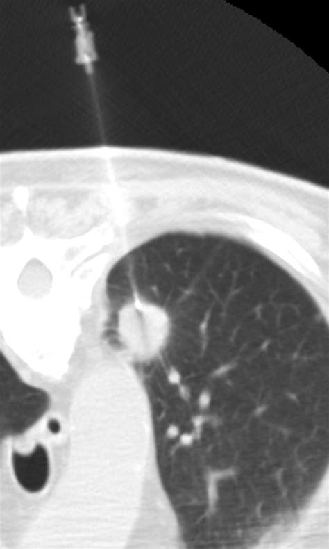 Ct Guided Percutaneous Needle Biopsy Of The Chest Preprocedural Evaluation And Technique Ajr