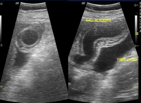 Diffuse gallbladder wall thickening (differential) | pacs