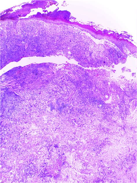 Invasive Clear Cell Variant Of Squamous Cell Carcinoma Mimicking