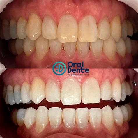 Antes E Depois Clareamento Dental Oral Dente