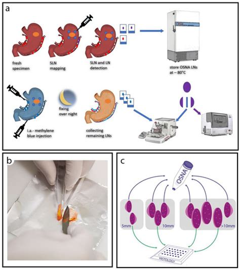 Cancers Free Full Text Ultrastaging Using Ex Vivo Sentinel Lymph