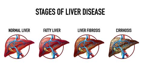 Fatty Liver Disease Causes Symptoms Treatment And Diet