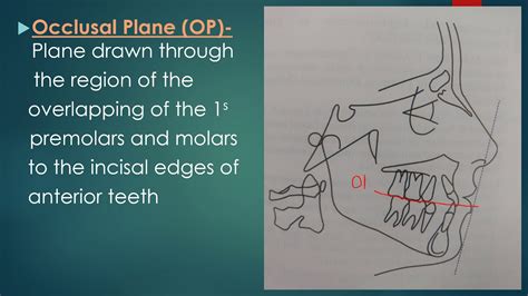 Cephalometric Planes Youtube