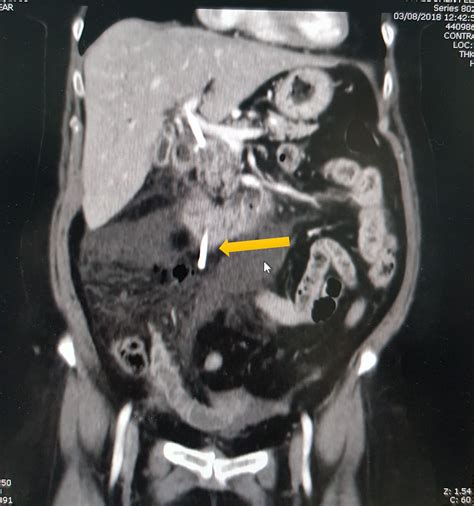 intraperitoneal duodenal perforation secondary  early migration