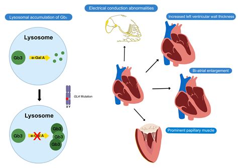 Cells Free Full Text Fabry Cardiomyopathy Current Practice And