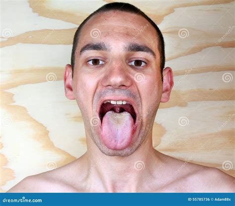 Infection Tongue Candida Albicans Stock Photo - Image: 55785736