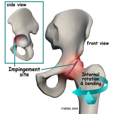 Hip Impingement | EDGE Physical Therapy in Omaha, Papillion, NE