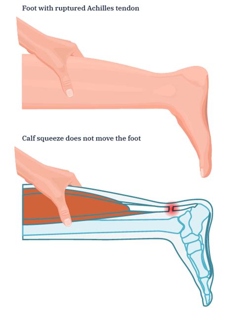 Achilles Tendon Rupture Symptoms And Treatment Options