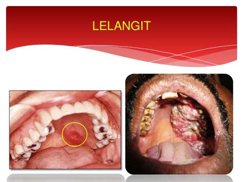 Kanser Mulut Oral