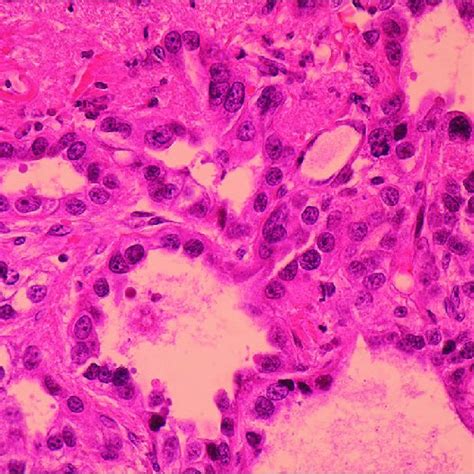 Tumor Cells With Hyperchromatic And Pleomorphic Nuclei And Conspicuous