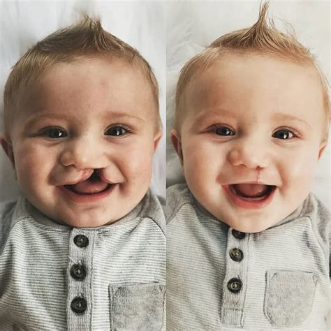 cleft lip and cleft palate, two week surgery : r/Damnthatsinteresting