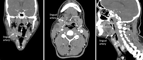 Management of the lingual artery in TORS – Head and Neck Robotic Surgery