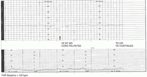 Fetal Heart Rate Pattern Interpretation Obgyn Key