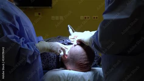 hair transplant surgery for balding man in hospital with dhi pencil. doctor performing the hair ...