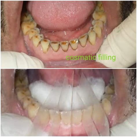 Tooth Surface Loss Management - Odontology Inn