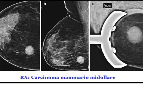 Carcinoma Mammario Papillare FertilityCenter