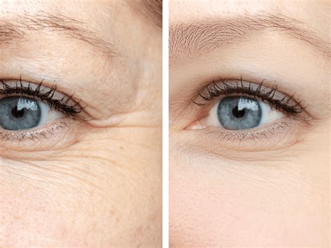 Como se livrar das rugas nos olhos (ou “pés de galinha”)? - Fabio Gontijo