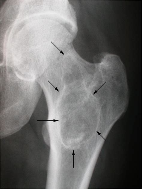 Fibrous Dysplasia And Mccunealbright Syndrome Imaging For Positive