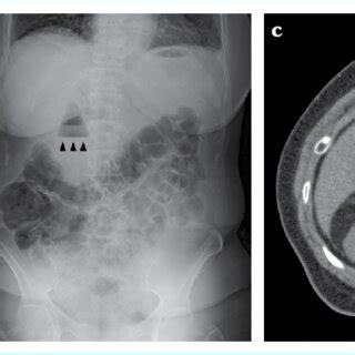 Plain Abdominal Radiographs Taken In The A Supine And B Erect