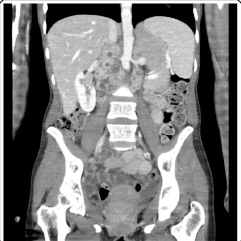 Ct Scan Of Abdomen With Label Hot Sex Picture