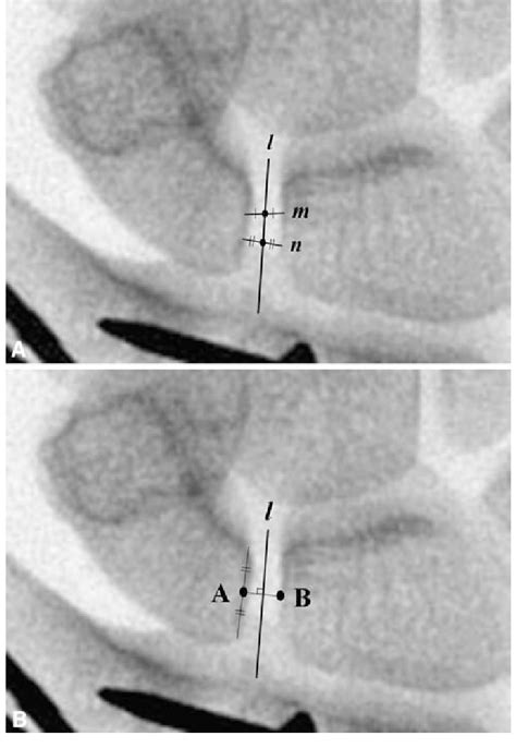 A B The Measurement Method Of The Scapholunate Gap Is Shown A A Line