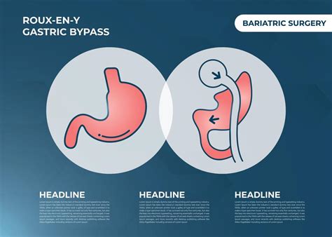 Roux En Y Gastric Bypass Rny Weight Loss Surgery Vector Illustration