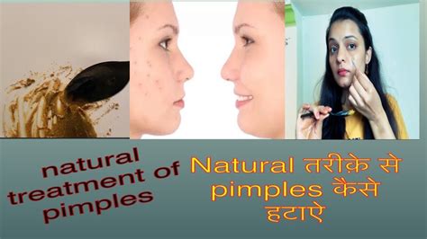 How To Remove Pimples Overnight Acne Treatment Thatglamsyou Youtube