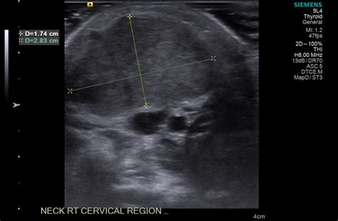 Fibromatosis Colli Image