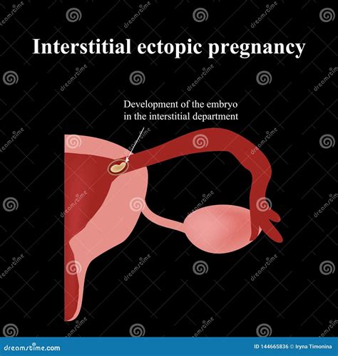 Development Of The Embryo In The Interstitial Department Ectopic