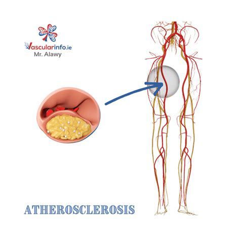 Femoral Popliteal Bypass Vascular Info