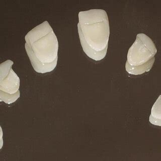 Ceramic veneers ready for the cementation procedure. | Download ...