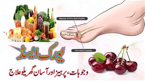 Uric Acid Ka Asan Gharelu Ilaj Uric Acid Treatment In Urdu By Easy