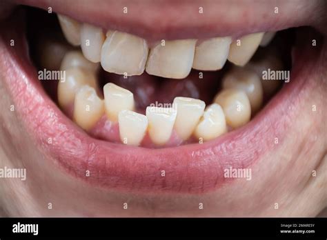 Adult Man Crooked Teeth Hi Res Stock Photography And Images Alamy