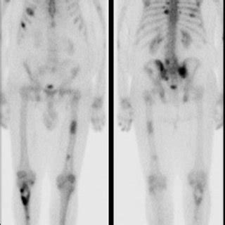 Tc M Mdp Bone Scan Anterior A And Posterior B Views Show Numerous