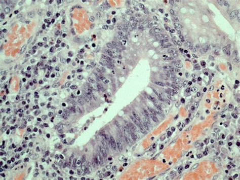 Pathology Outlines Ulcerative Colitis