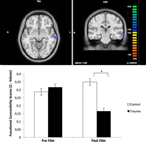 Functional Connectivity Analyses With Left Amygdala Seed Resulted Into Download Scientific