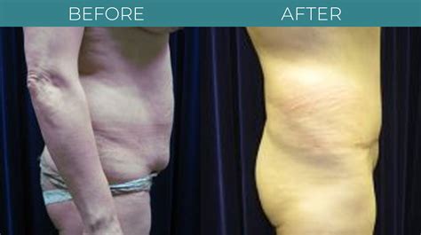 Tummy Tuck Sterling Virginia Berman Cosmetic Surgery