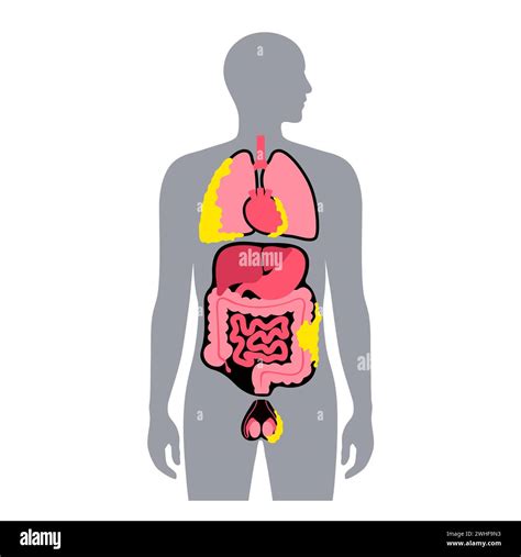 Mesothelioma Tumour Types Illustration Stock Photo Alamy