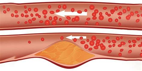 ᐅ Přírodní léky na vysoký cholesterol iMed Guru