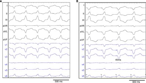 Twelve Lead Electrocardiograms During VT A The VT Manifests A Left