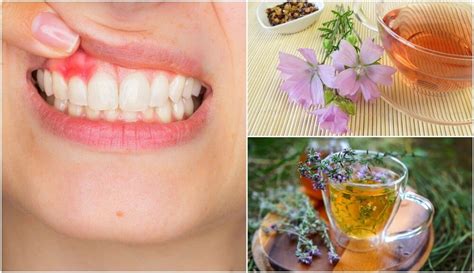 5 soluciones naturales para controlar los síntomas de la gingivitis