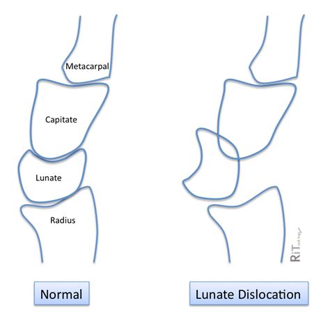 RiT radiology: Lunate Dislocation