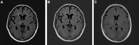 Cavitation Of Deep Lacunar Infarcts In Patients With First Ever Lacunar