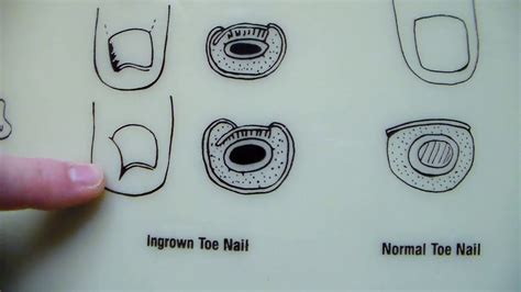 The Right Way To Cut Your Toenails 6 Steps Experienced Idaho