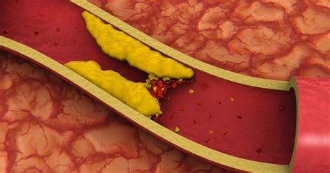 10 Coisas que Você Precisa Saber Sobre Dislipidemia Clinica Médica em