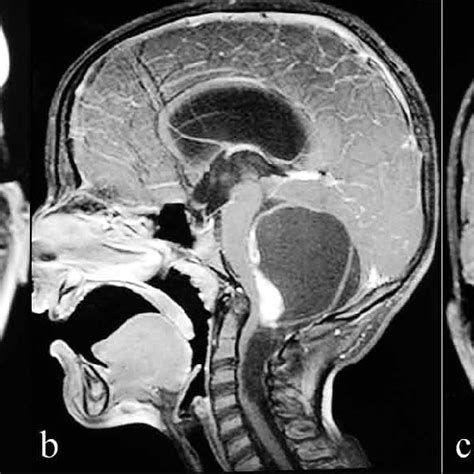 A Large Cystic Midline Mass With Anteriorly Located Enhancing Solid